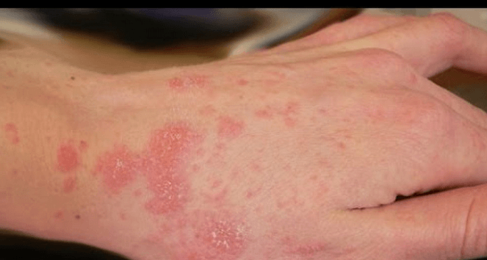 Scabies and effective herbal treatments for people - McDowell's Herbal  Treatments