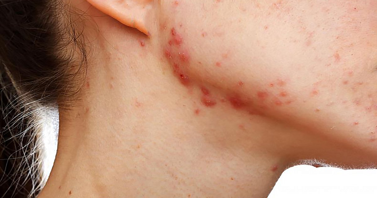 Scabies and effective herbal treatments for people - McDowell's Herbal  Treatments