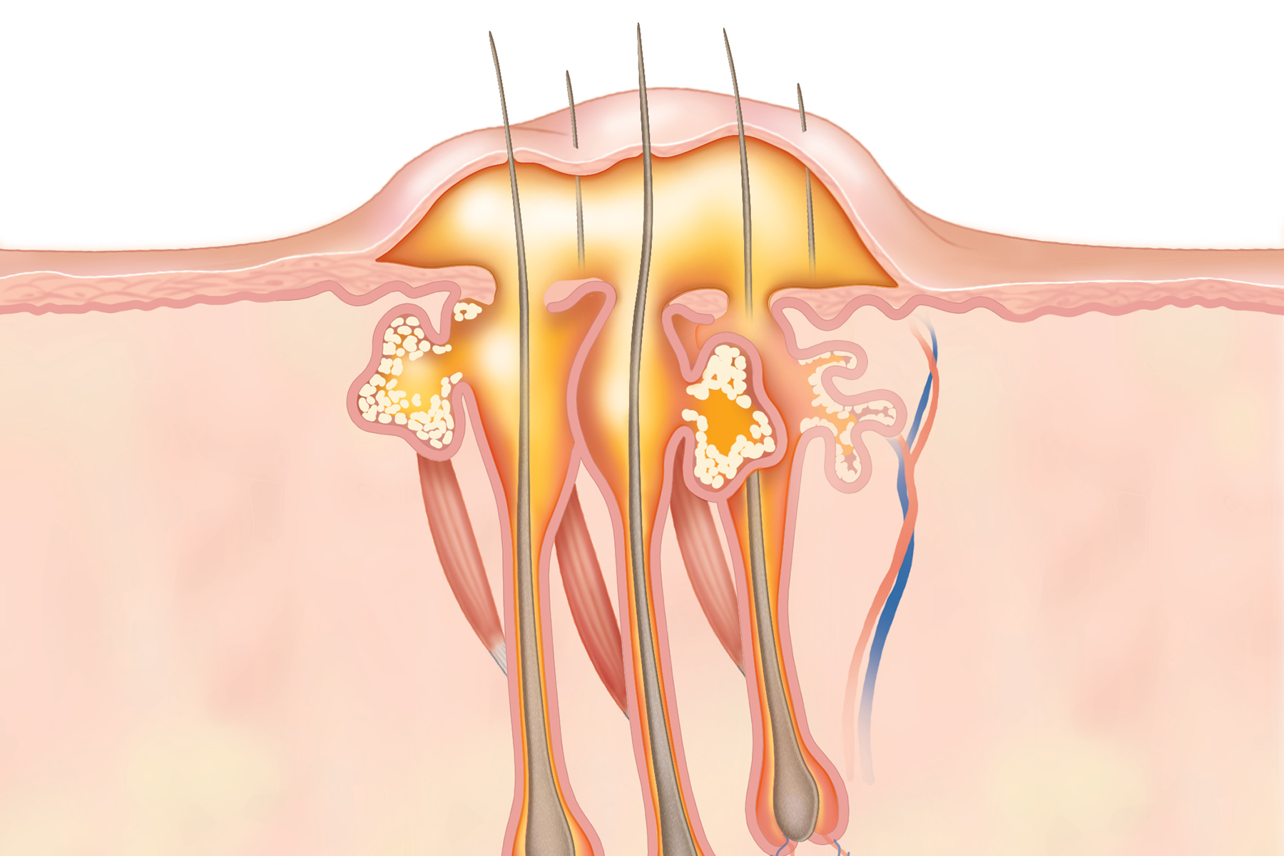 Irritated hair follicles causes symptoms diagnosis  treatment