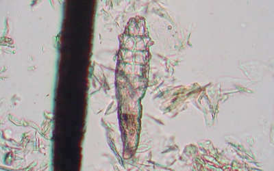 demodex with follcile