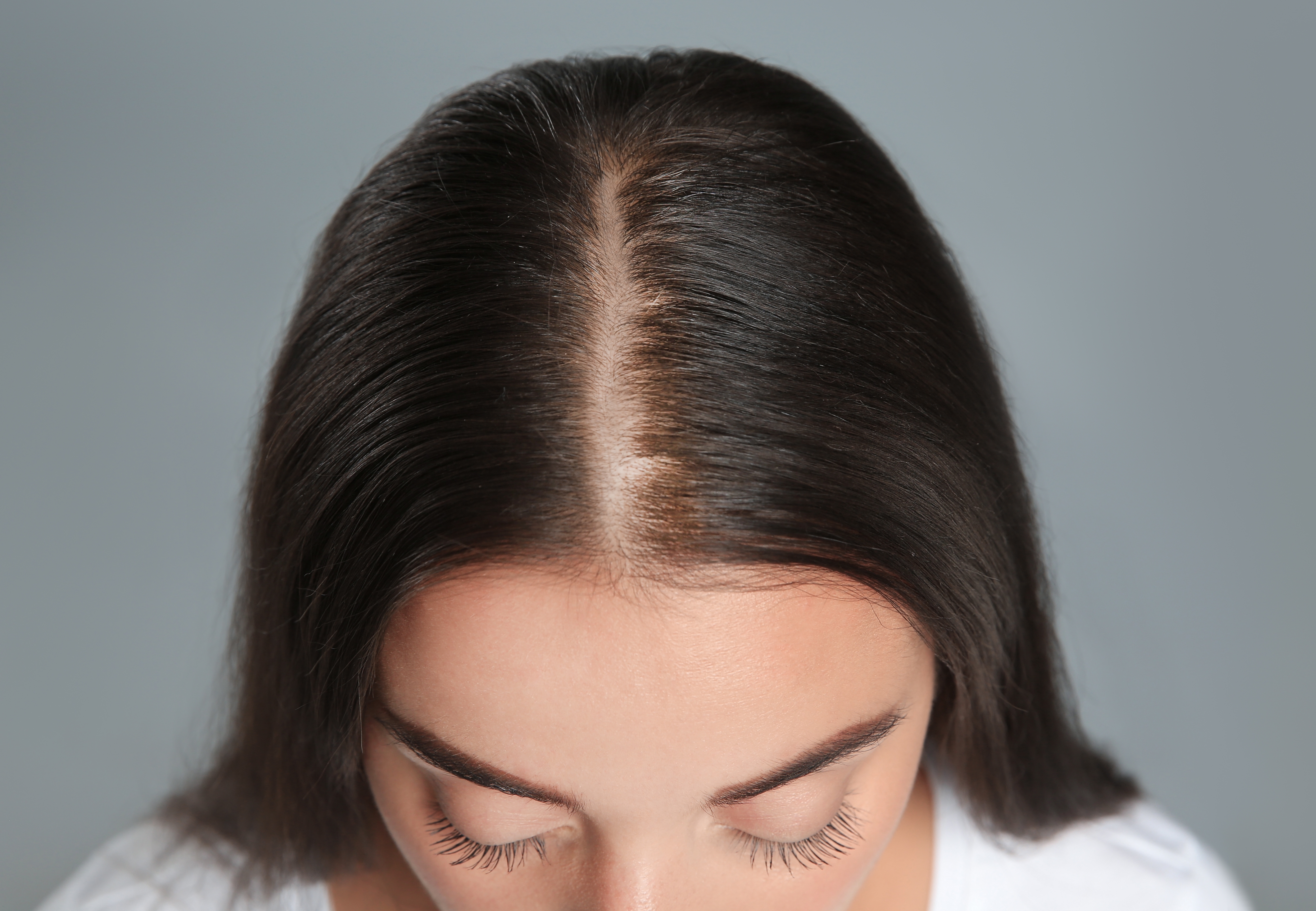 Alopecia and sudden hair loss - McDowell's Herbal Treatments