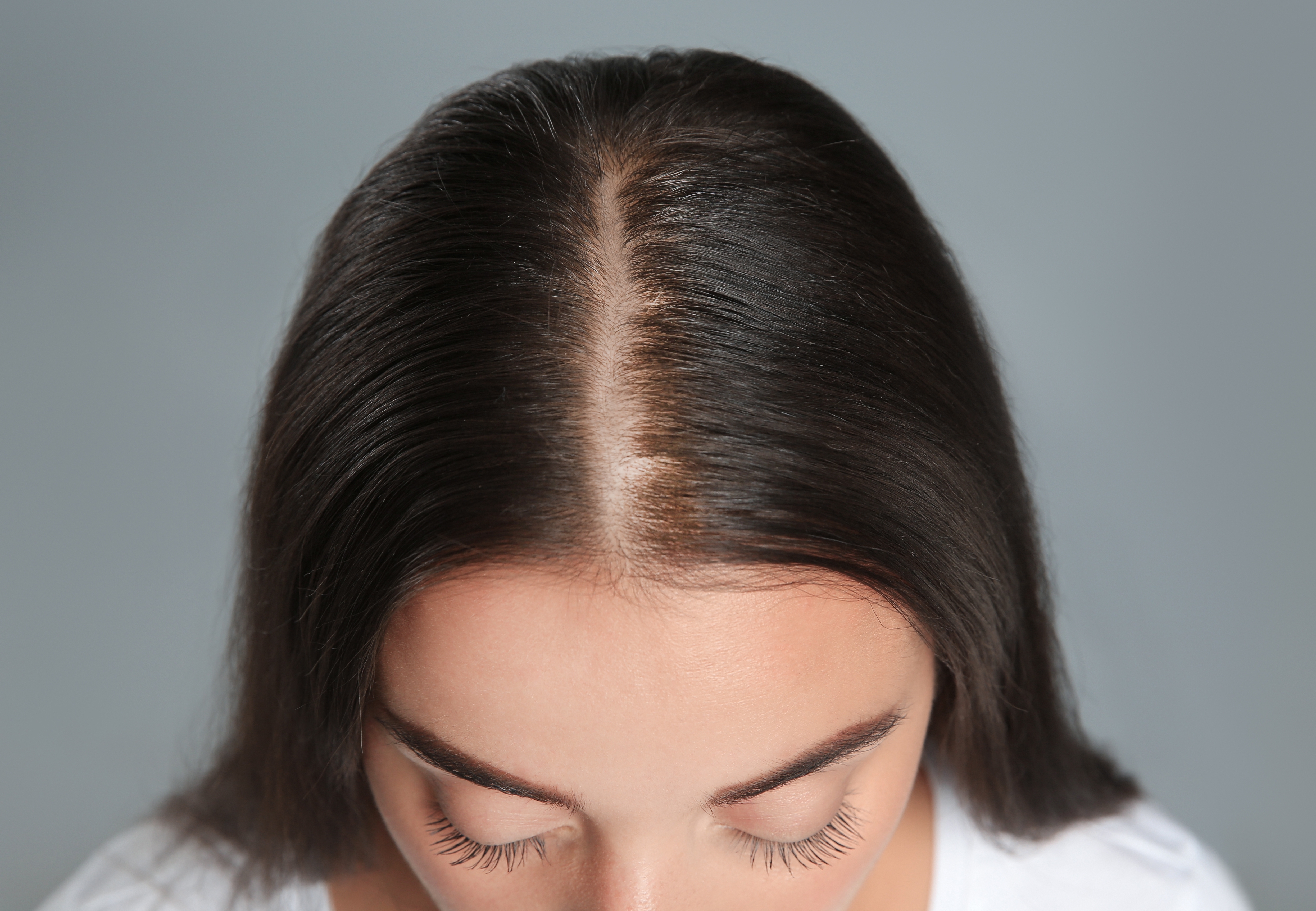 Woman with hair loss problem before and after treatment on grey background, collage. Visiting trichologist