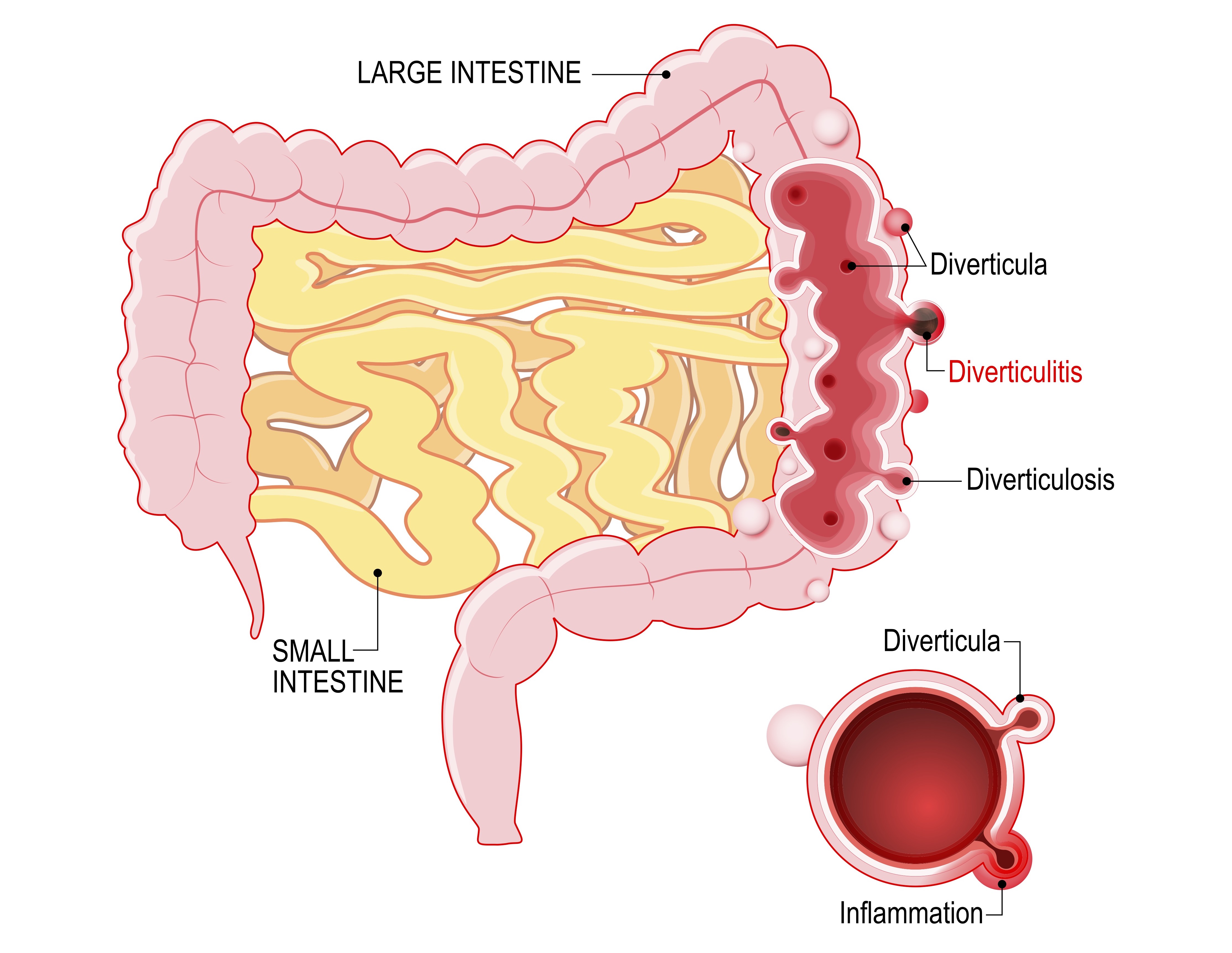 stock diverticulitis SML