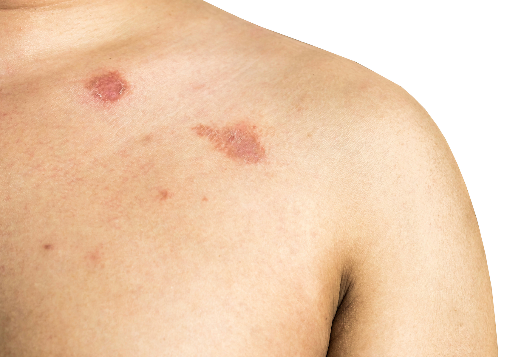 The Red Circle On Your Skin Might Not Be Ringworm; What Else Could It Be?