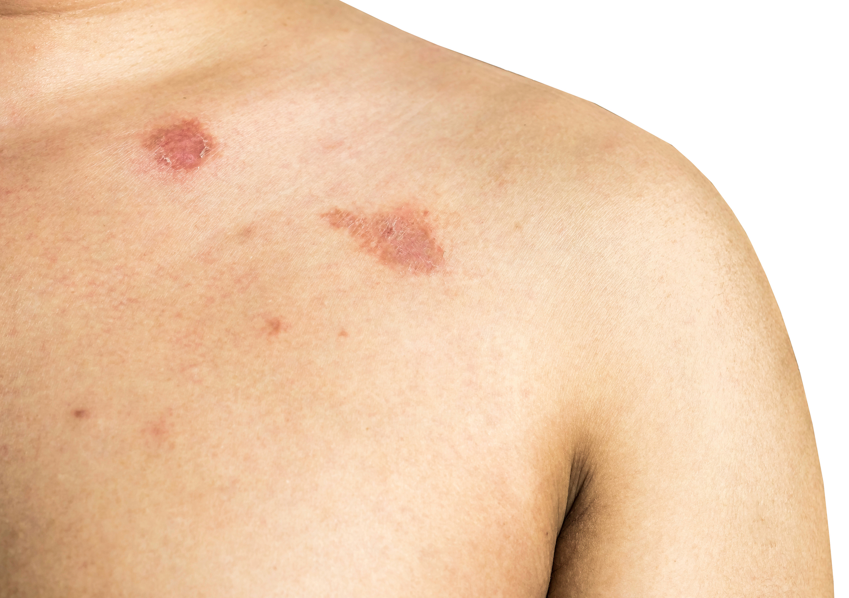 Tinea Corporis: Symptoms, Causes, Treatment, and More