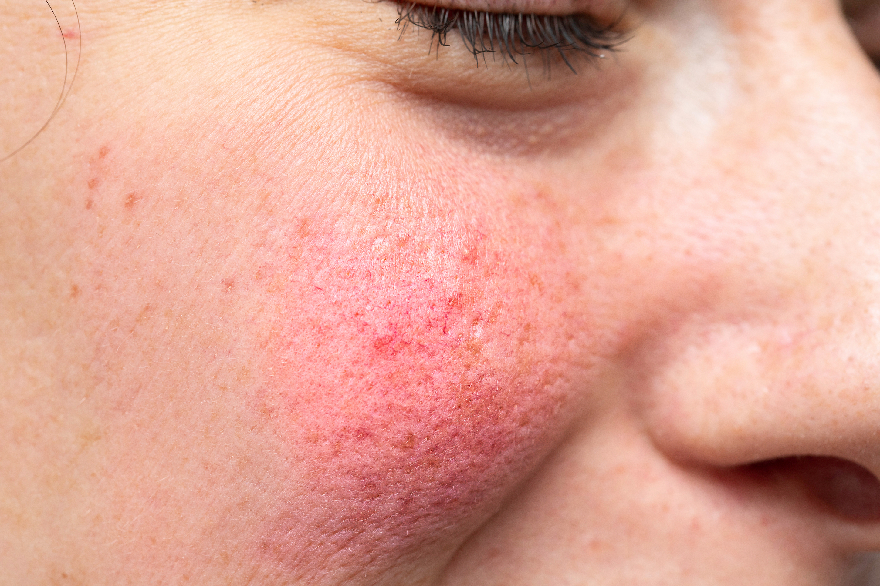 stock rosacea SMLL