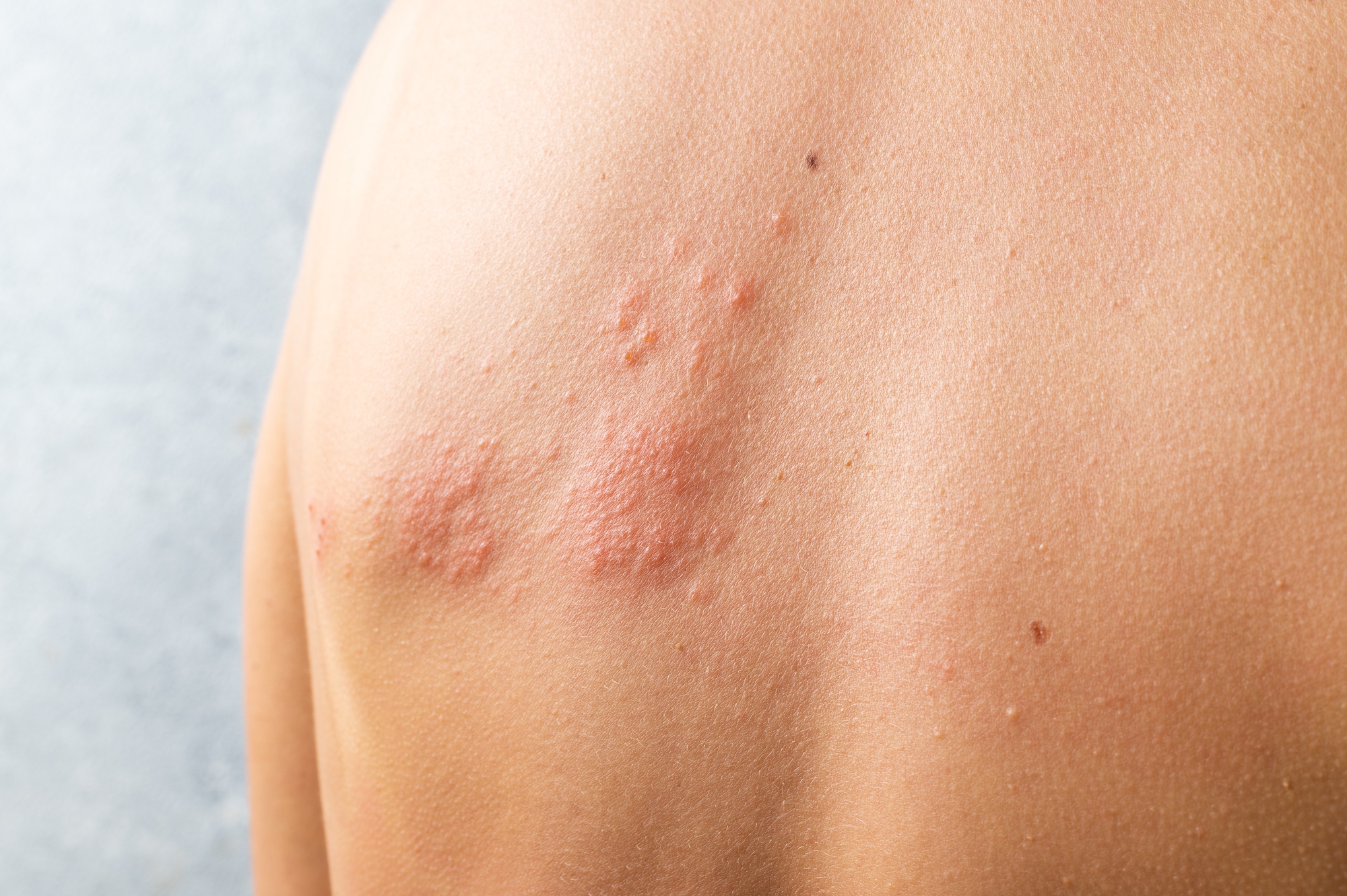 Skin infected Herpes zoster virus. Herpes Virus on body. urticaria rash. atopic dermatitis on body.