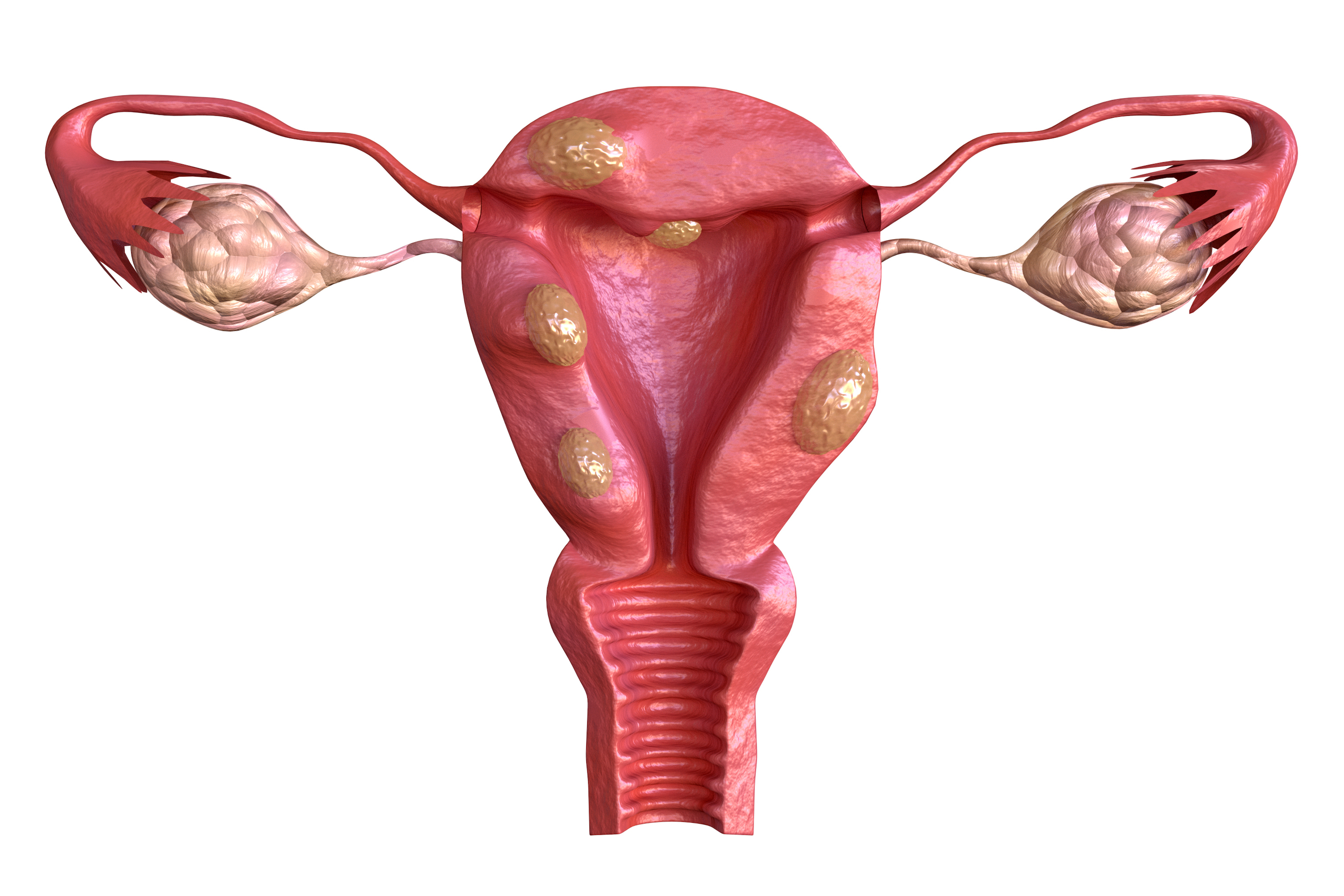 uterine fibroid are benign solid tumors formed by muscle tissue. Its size can vary greatly and some cause large abdomen increase. 3D rendering