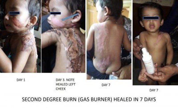 testimonial second degree burns child